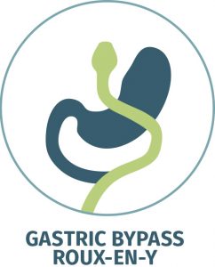 Roux-en-Y Gastric Bypass, RNY Bypass