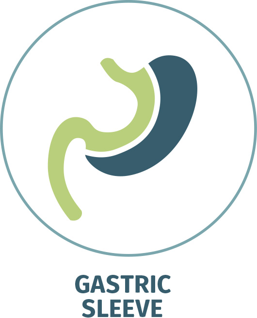 Gastric Sleeve, Sleeve Gastrectomy, VSG