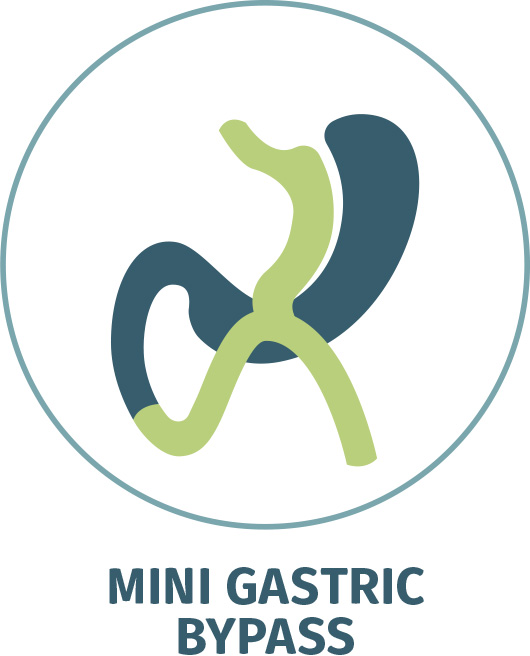 Mini Gastric Bypass, Single Loop Gastric Bypass